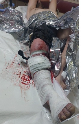 إصابة راعٍ برصاص الاحتلال في دير بلوط